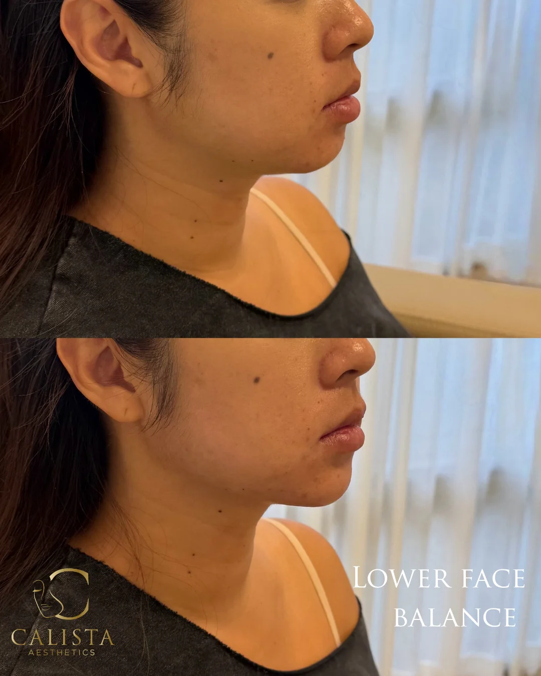 Two vertically stacked side-profile photographs labeled lower face balance.