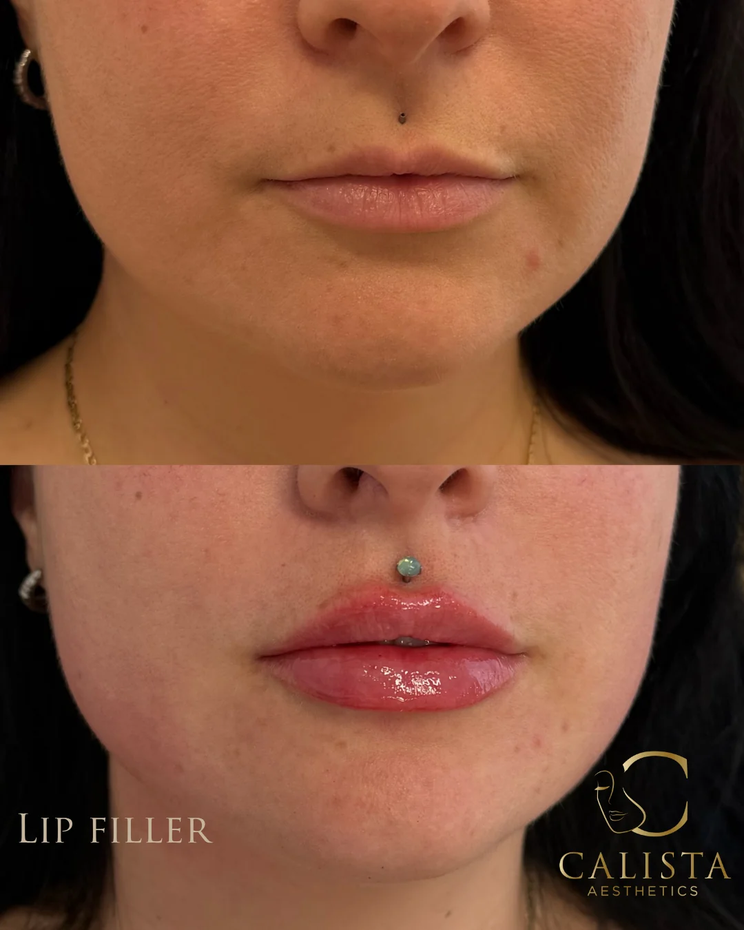 Two vertically stacked close-up photographs of the lips, labeled lip filler.