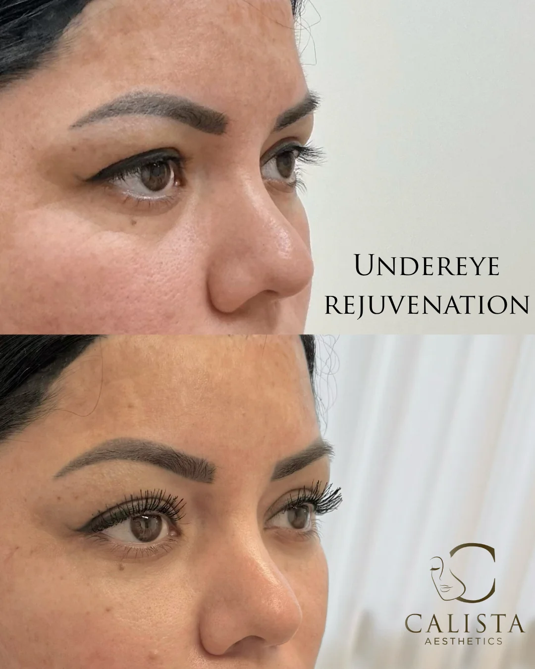Undereye rejuvenation by Joanne Lim at Calista Aesthetics, shown in two vertically stacked three-quarter close-ups of the eye and undereye area.