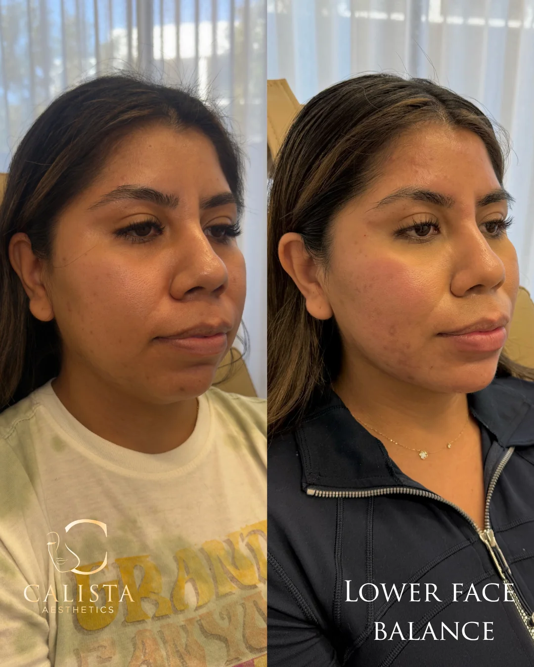 Two side-by-side three-quarter photographs of the face, labeled lower face balance.