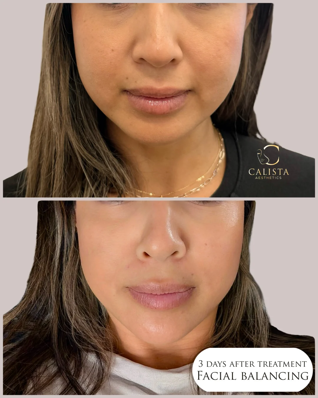 Facial balancing by Joanne Lim at Calista Aesthetics, shown in two vertically stacked front-view photographs; the lower photograph is labeled three days after treatment.