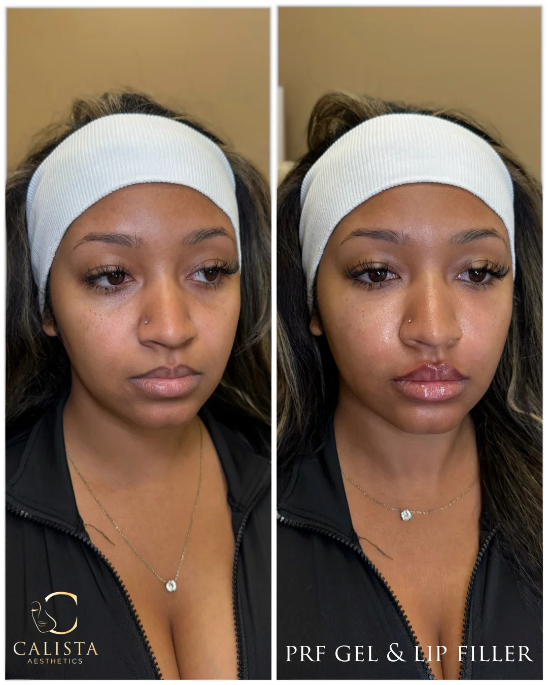 Two side-by-side front-view photographs labeled PRF gel and lip filler.