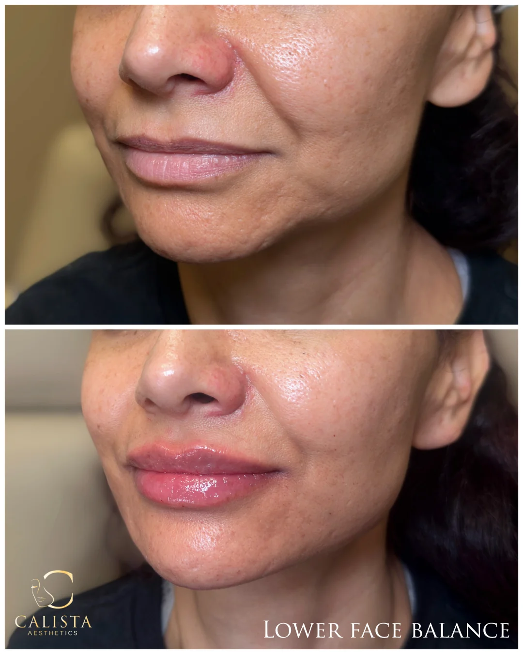 Two vertically stacked three-quarter close-ups of the lips and lower face, labeled lower face balance.
