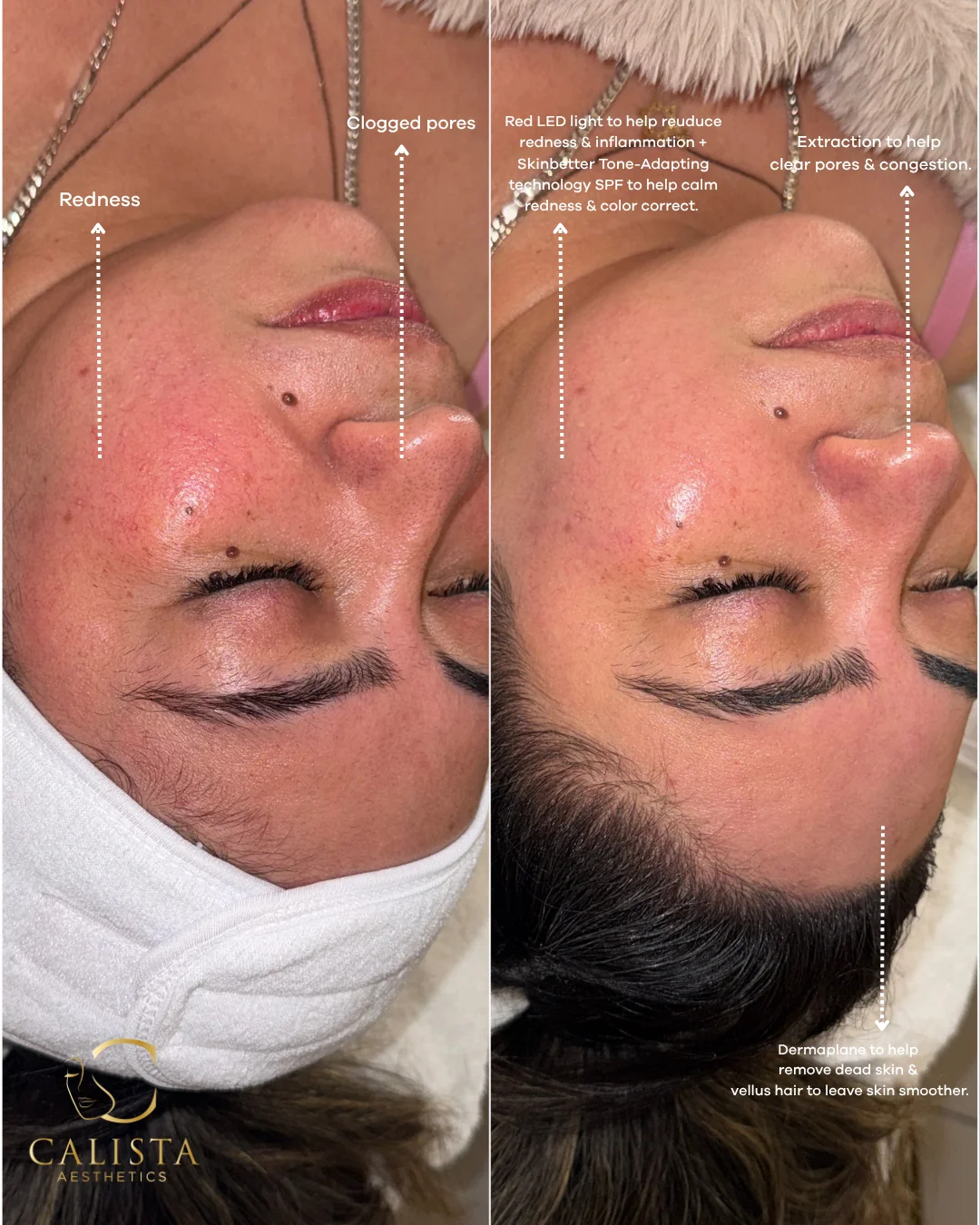 Annotated facial comparison showing dermaplaning, extractions, red LED light therapy and SPF around the cheek and nose.