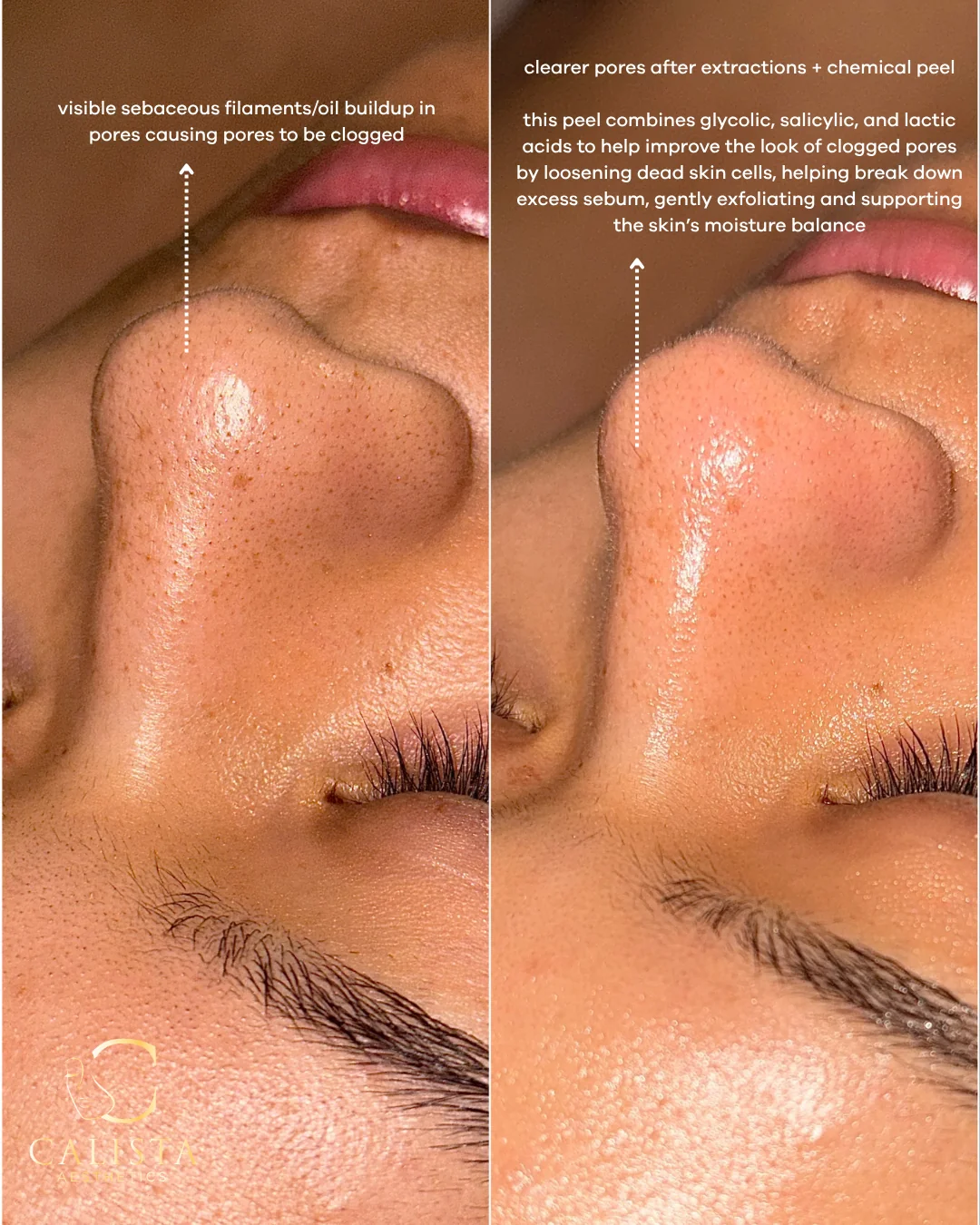 Before-and-after nose close-ups with labels for clogged pores, extractions and a chemical peel.