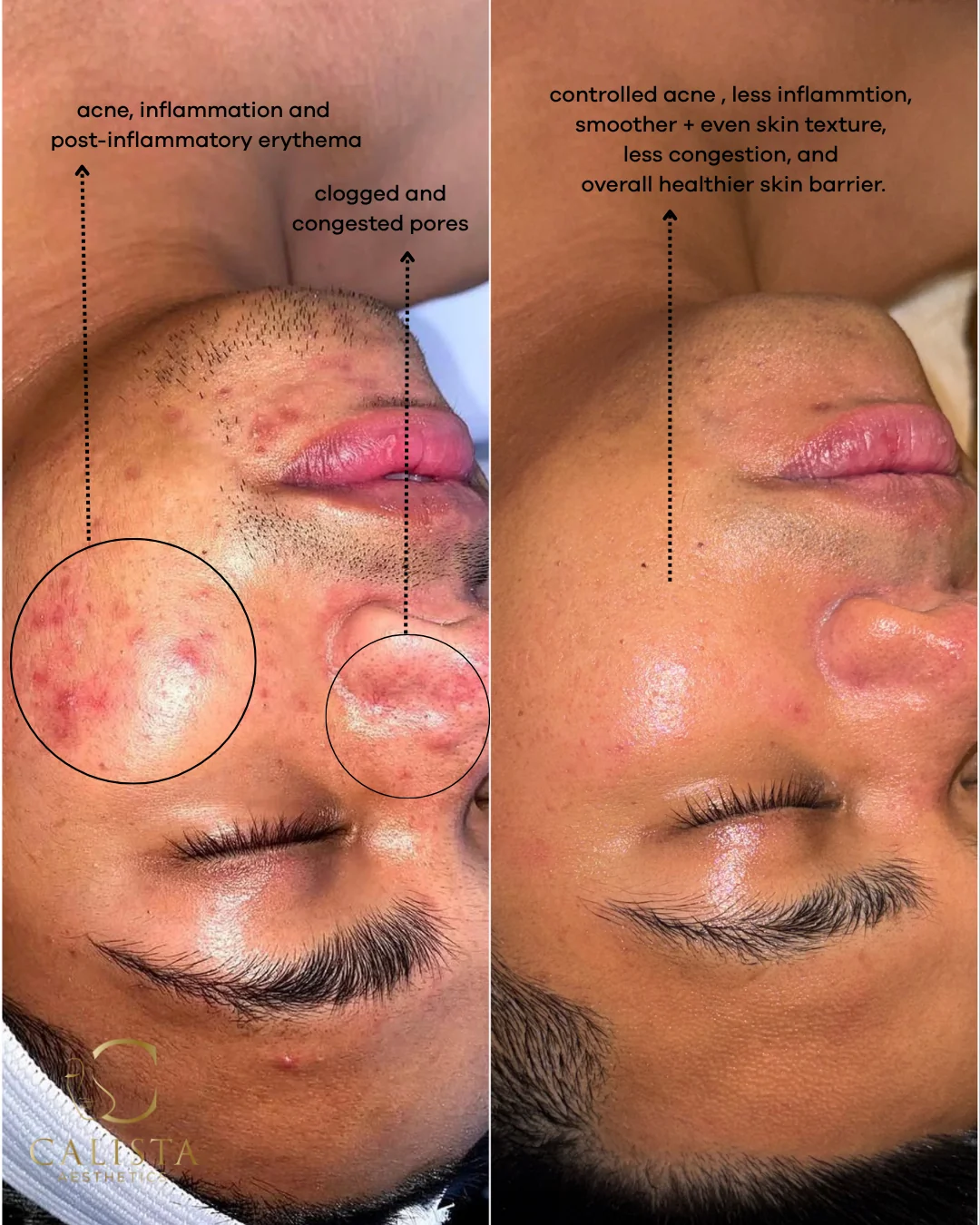 Annotated before-and-after cheek and nose close-ups from facials, chemical peels and a tailored skincare regimen.