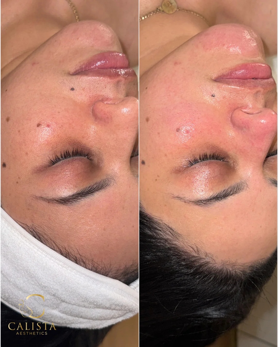 Close-up before-and-after photos of the cheek, nose and chin from a Glass Skin Facial at Calista Aesthetics.