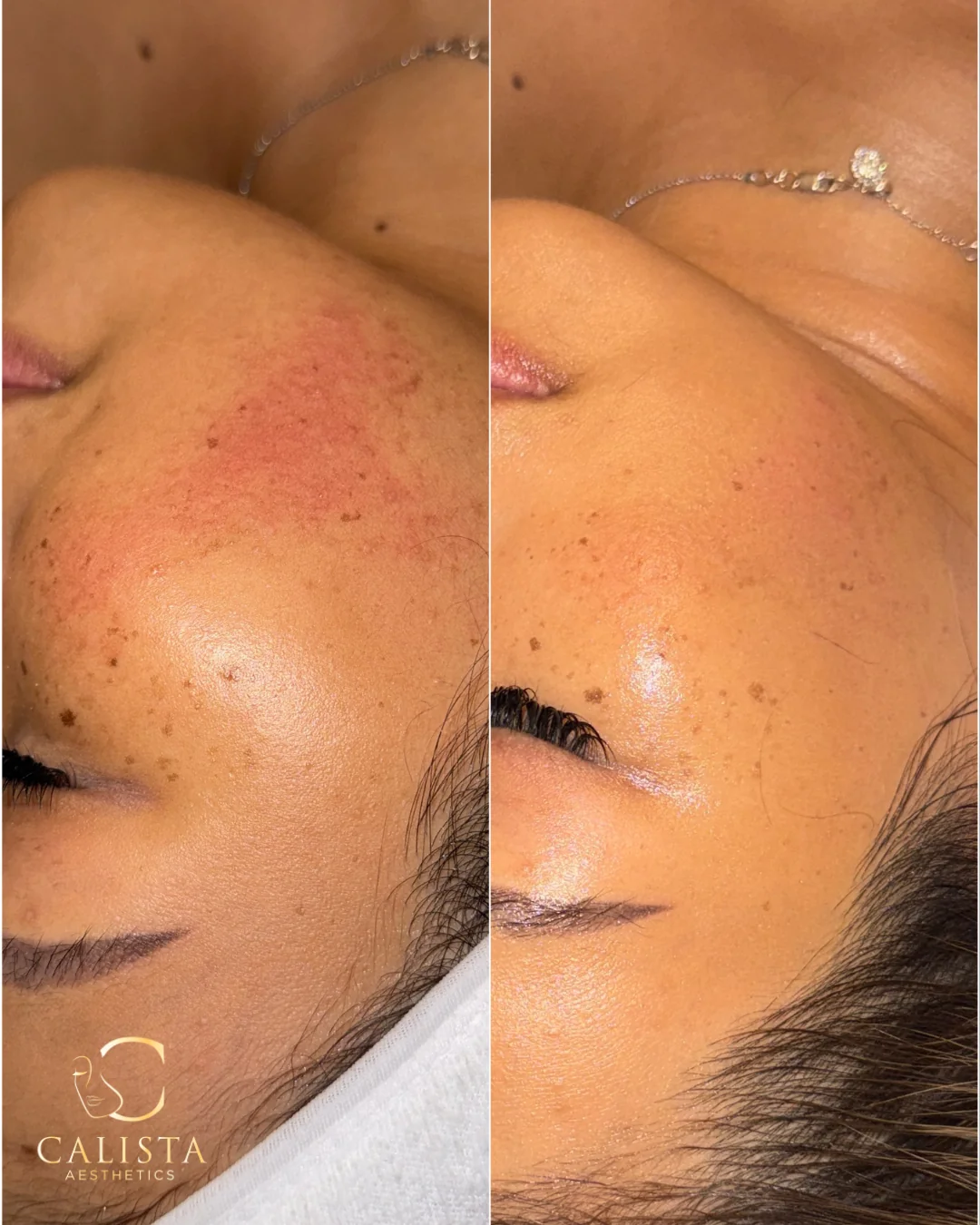 Side-by-side cheek close-ups documenting care for keratosis pilaris, with the Calista logo.