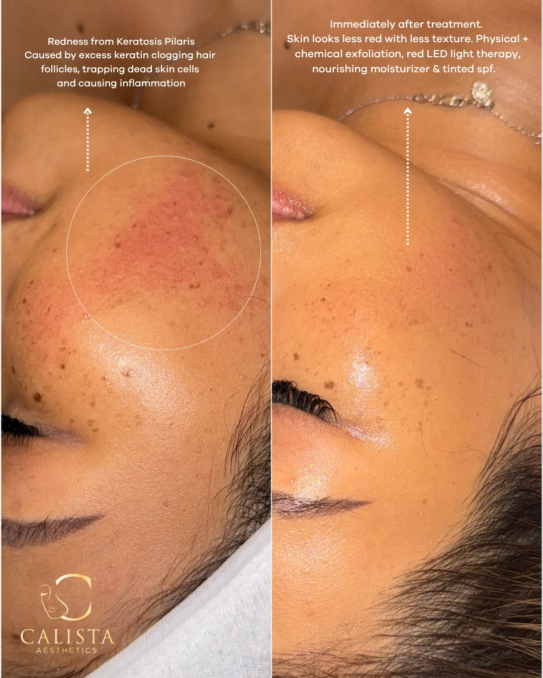 Annotated cheek comparison showing exfoliation, red LED light therapy, moisturizer and tinted SPF for keratosis pilaris care.