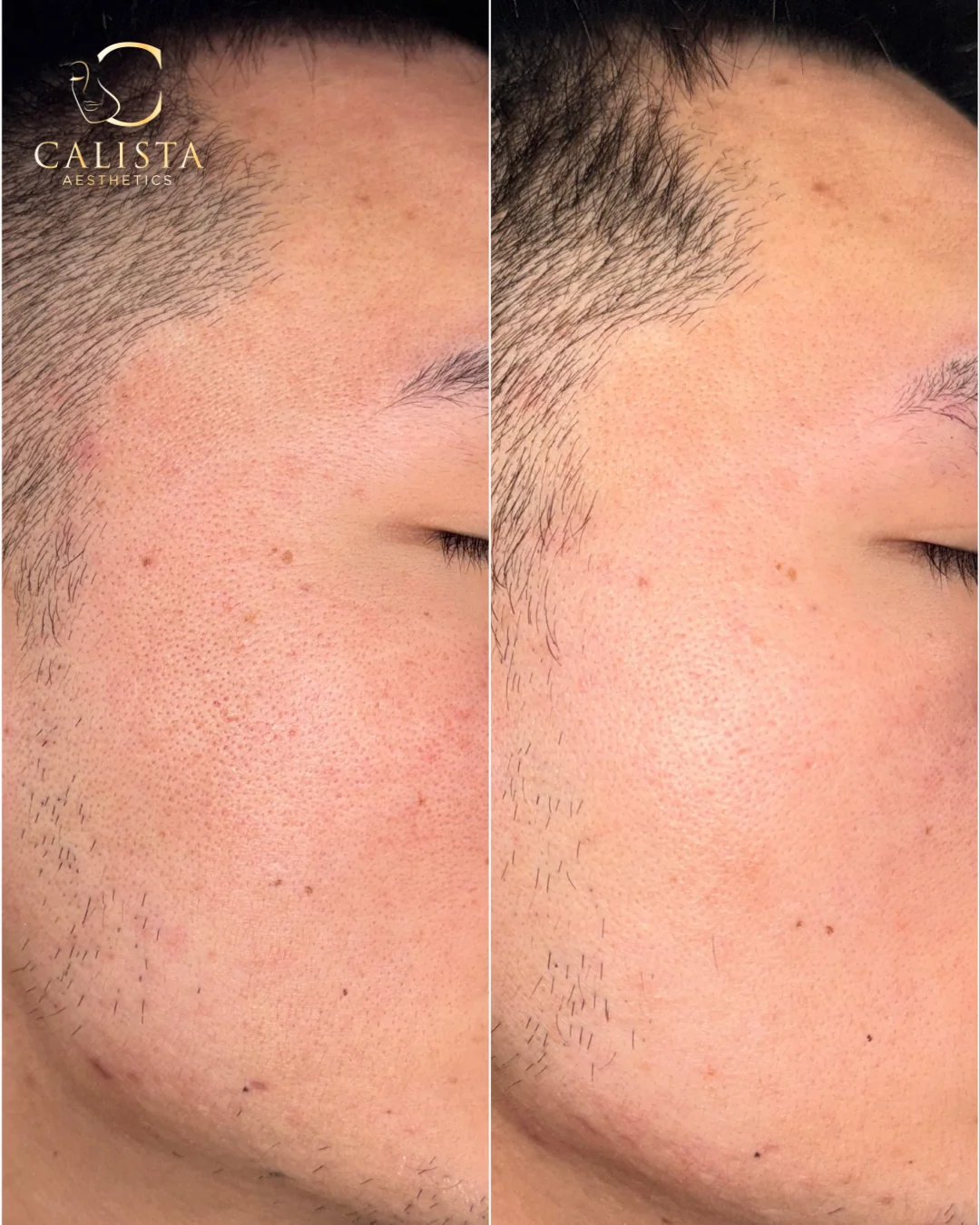 Before-and-after cheek and temple close-ups following a Marini Skin Care Management System routine.