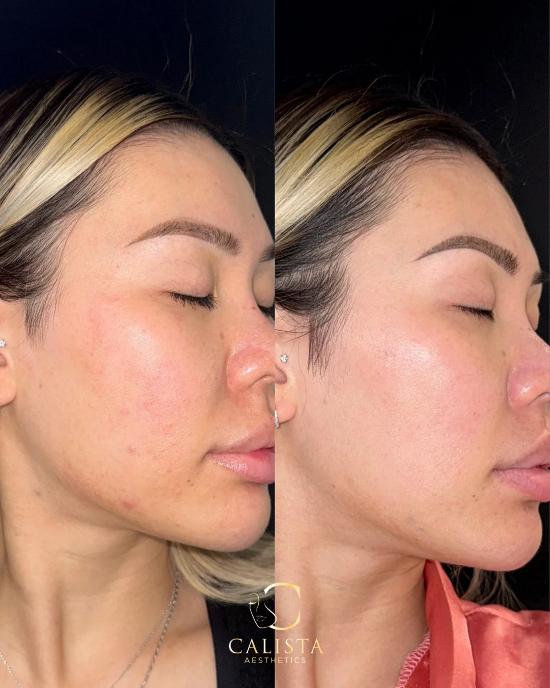 Side-by-side right-facing profile photos from a VI Peel at Calista Aesthetics.