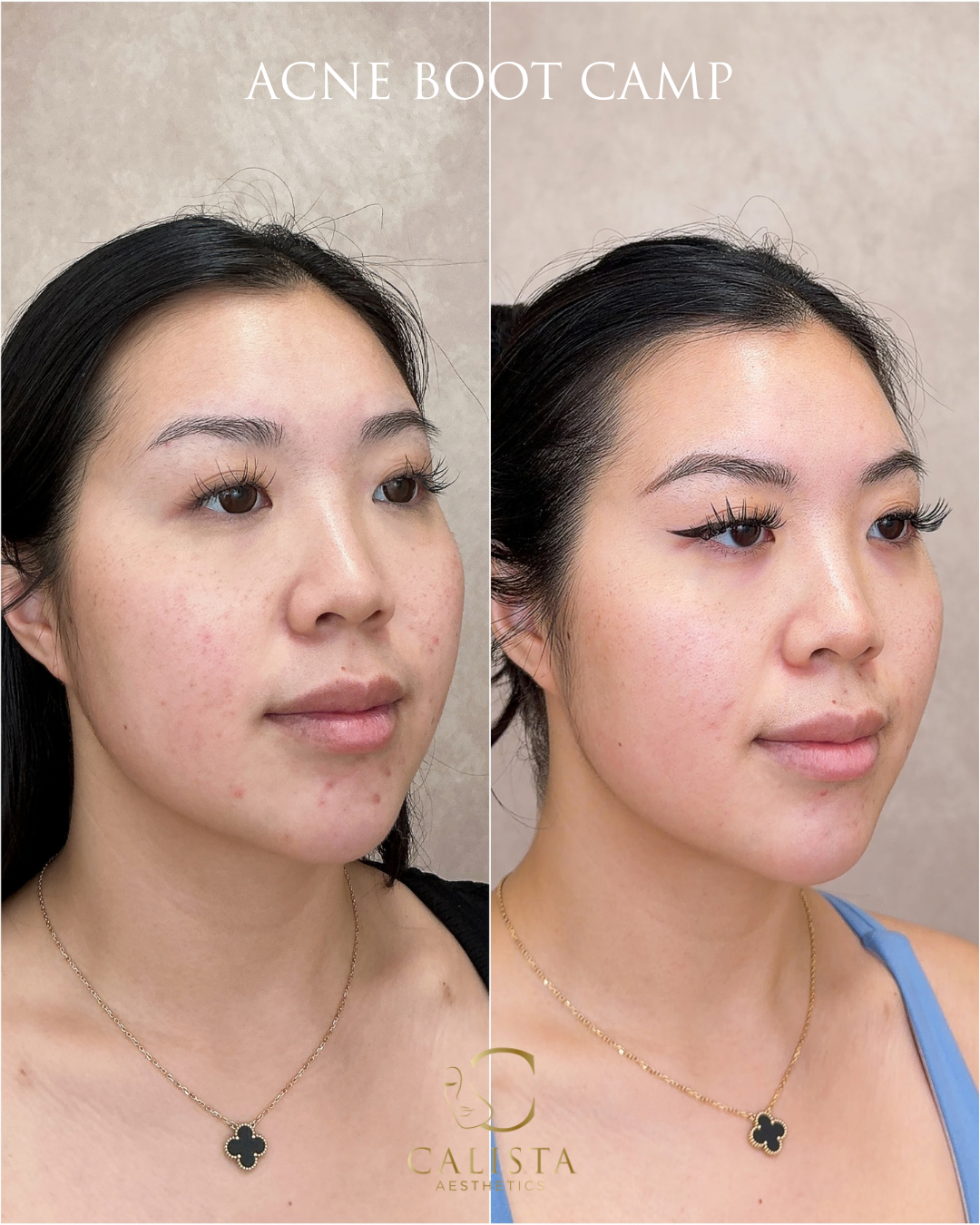 Side-angle before-and-after photographs from the same Acne Boot Camp case.
