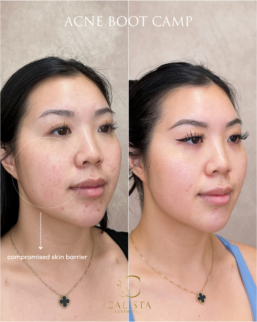 The same side-angle comparison with a circle, arrow and the source label “compromised skin barrier.”