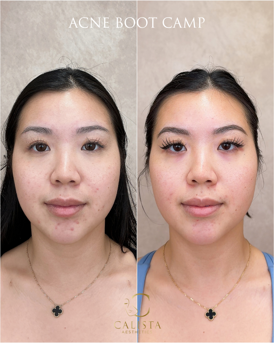 Front-facing before-and-after photographs in the Acne Boot Camp case graphic.