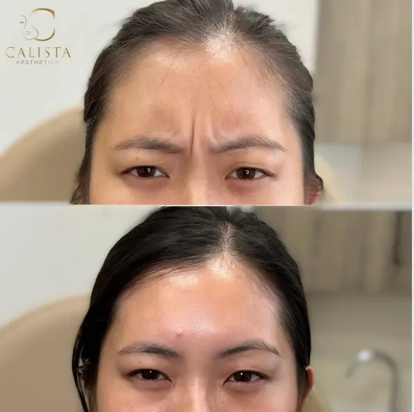 Before and after images of a woman showing the results of a forehead treatment. The "before" image displays visible frown lines and wrinkles between the eyebrows, while the "after" image shows a smooth, wrinkle-free forehead with relaxed facial muscles.