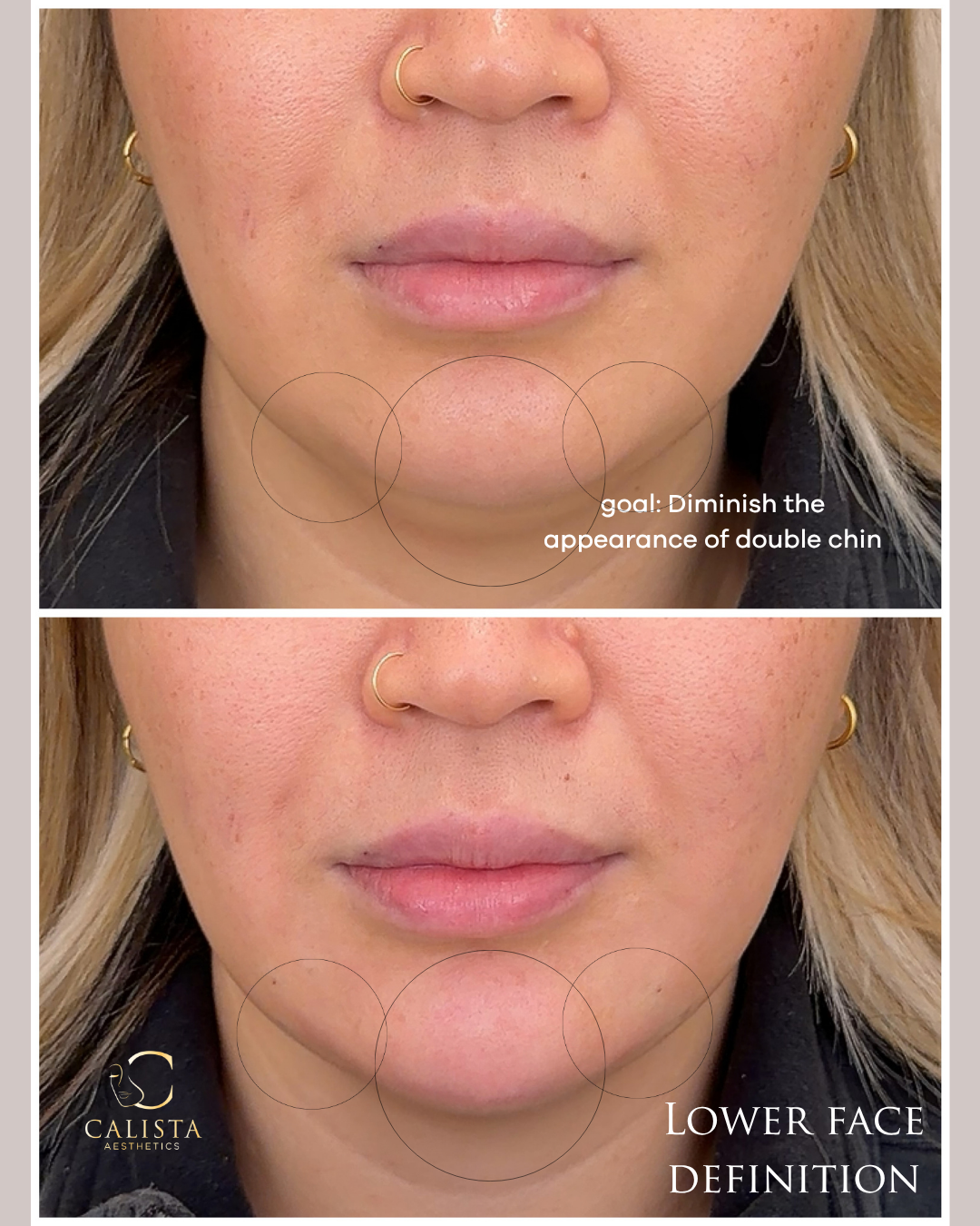 Paired lower-face close-ups with circles around the chin and adjacent areas and a double-chin appearance goal annotation.
