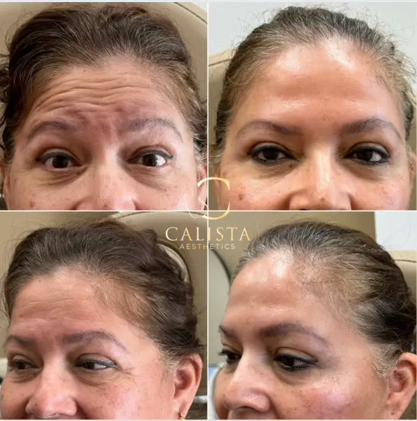 Before and after images of a middle-aged woman showing the results of a facial treatment targeting forehead lines and wrinkles. The "before" images highlight prominent forehead creases and lines, while the "after" images reveal smoother skin with significantly reduced wrinkles and a more rejuvenated appearance from multiple angles. Cheek filler, chin shadow, anti-wrinkle treatment for upper and lower face.