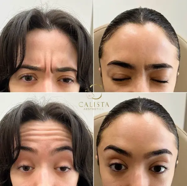 Before and after images of a woman showing the results of a treatment targeting frown lines and forehead wrinkles. The "before" images display deep frown lines between the eyebrows and prominent horizontal lines on the forehead. The "after" images reveal a smoother forehead with significantly reduced lines and a more relaxed appearance.