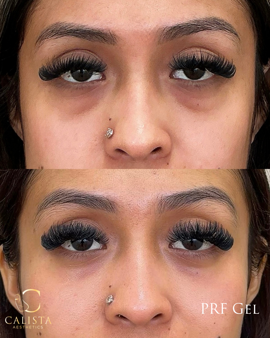 Two stacked close-up photographs of the under-eye area in Calista’s PRF Gel comparison.