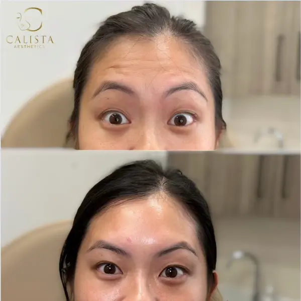 Before and after images of a woman showing the results of a forehead tox treatment. The before image reveals visible wrinkles and fine lines on the forehead when raising her eyebrows, while the after image displays a smoother and more relaxed forehead.