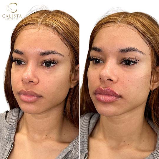 Before and after transformation of a young woman with light brown skin, highlighting fuller lips and balanced facial features after a lip enhancement treatment by Calista Aesthetics. Lip filler, cheek filler, chin filler.