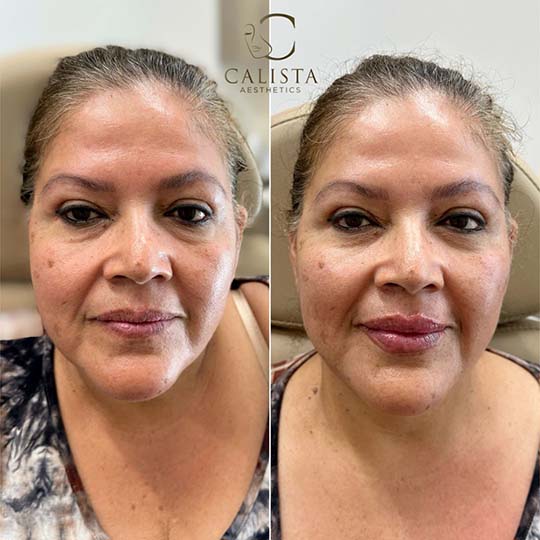Before and after facial aesthetics treatment on a middle-aged woman with a warm skin tone, demonstrating enhanced lip volume and a smoother, more defined facial appearance at Calista Aesthetics. Cheek filler, chin shadow, anti-wrinkle treatment for upper and lower face.