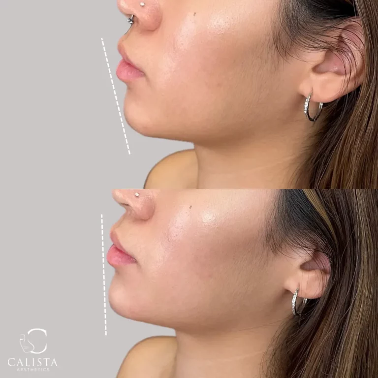 Before and after images of a woman showing the results of a chin enhancement treatment. The "before" image highlights a less defined chin profile, while the "after" image reveals a more pronounced and balanced chin projection, creating a more contoured and aesthetically pleasing facial profile. Chin filler.