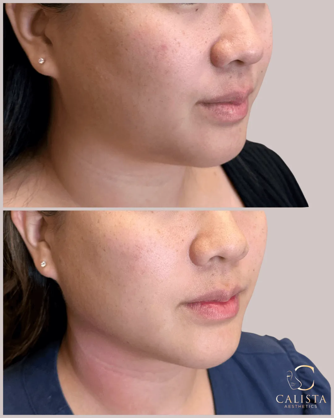 Before and after comparison of a woman’s lower face showing improved skin tone and smoother texture on the cheek and jawline, with Calista Aesthetics logo in the corner