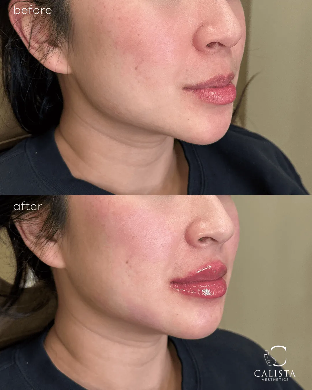 Side-angle before and after image of a woman with plumper, more contoured lips and natural definition achieved through filler at Calista Aesthetics.