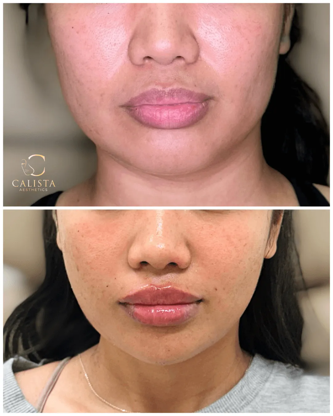 Close-up before and after photo of a woman’s lips displaying fuller shape, smoother texture, and improved symmetry after lip filler treatment at Calista Aesthetics.