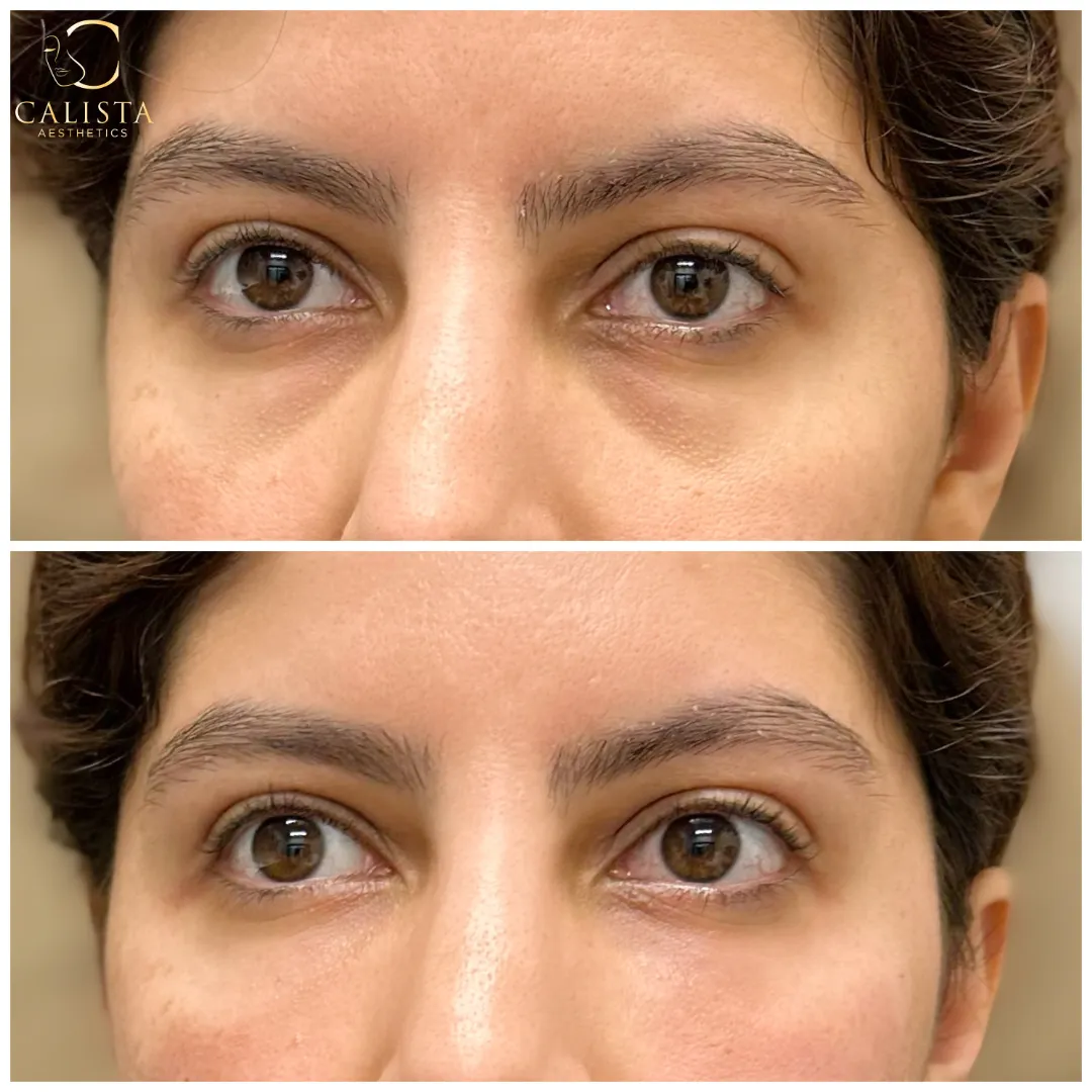 Before-and-after close-up image of a woman's eyes showing visible improvements in under-eye texture and brightness. Under eye treatment, prf ez gel.