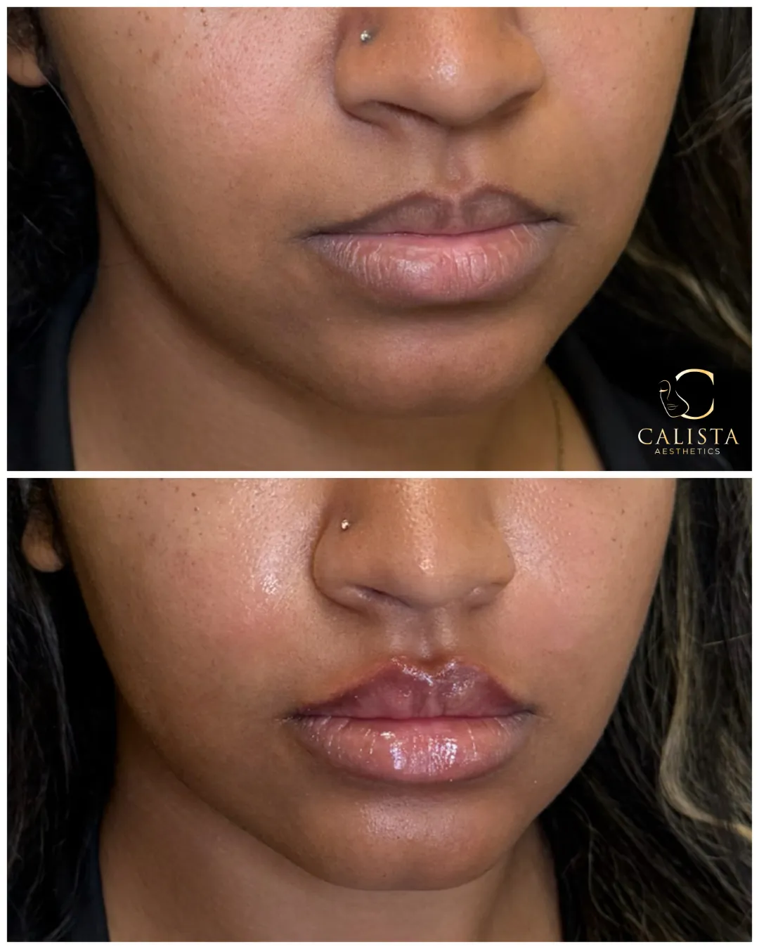 Close-up before and after image of a woman's lips showing increased volume, definition, and hydration after lip filler treatment at Calista Aesthetics.