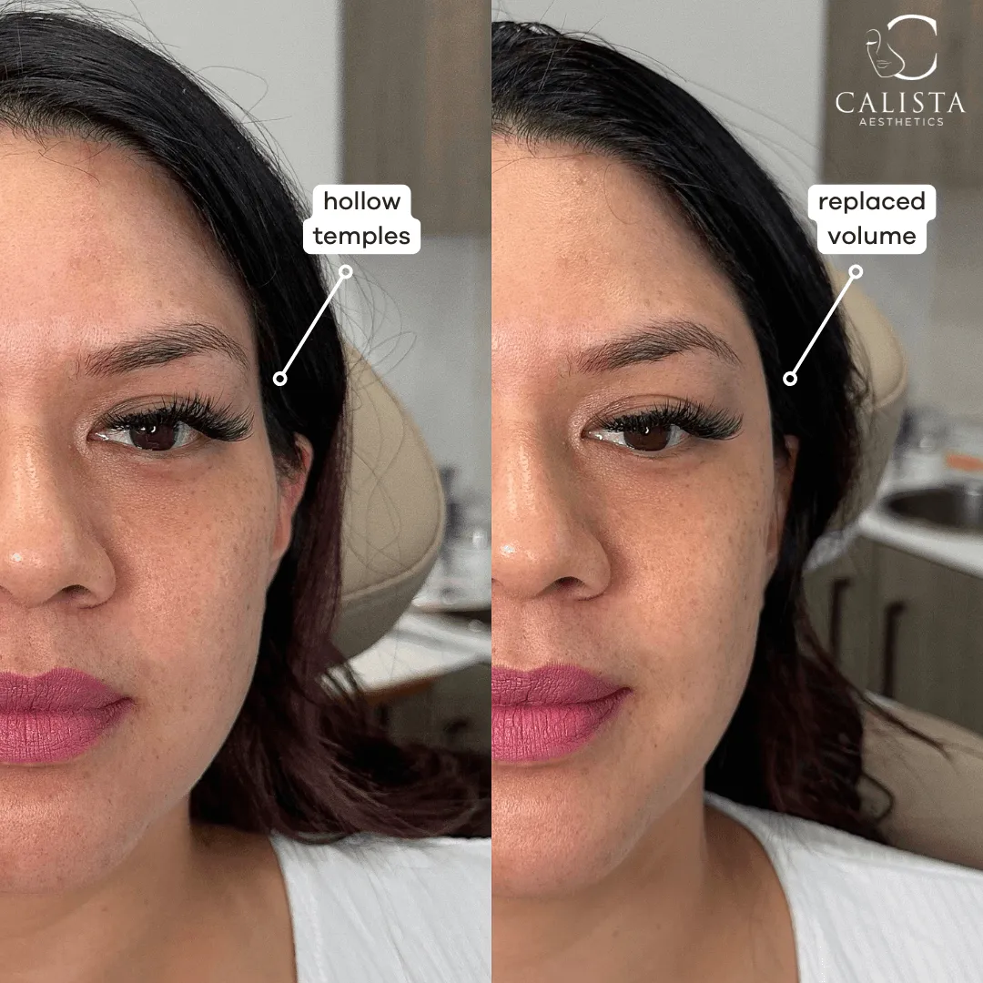Before and after comparison of a woman’s face showing hollow temples on the left and restored volume on the right, with labeled callouts and Calista Aesthetics logo in the corner