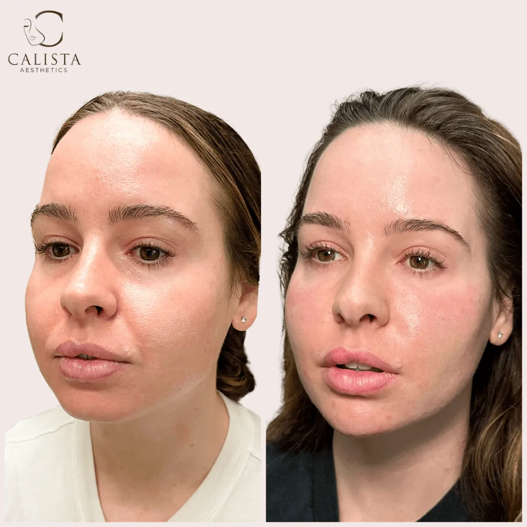Side-by-side before and after images of a woman showing fuller lips, enhanced facial volume, and a more hydrated, glowing complexion following a cosmetic treatment at Calista Aesthetics.