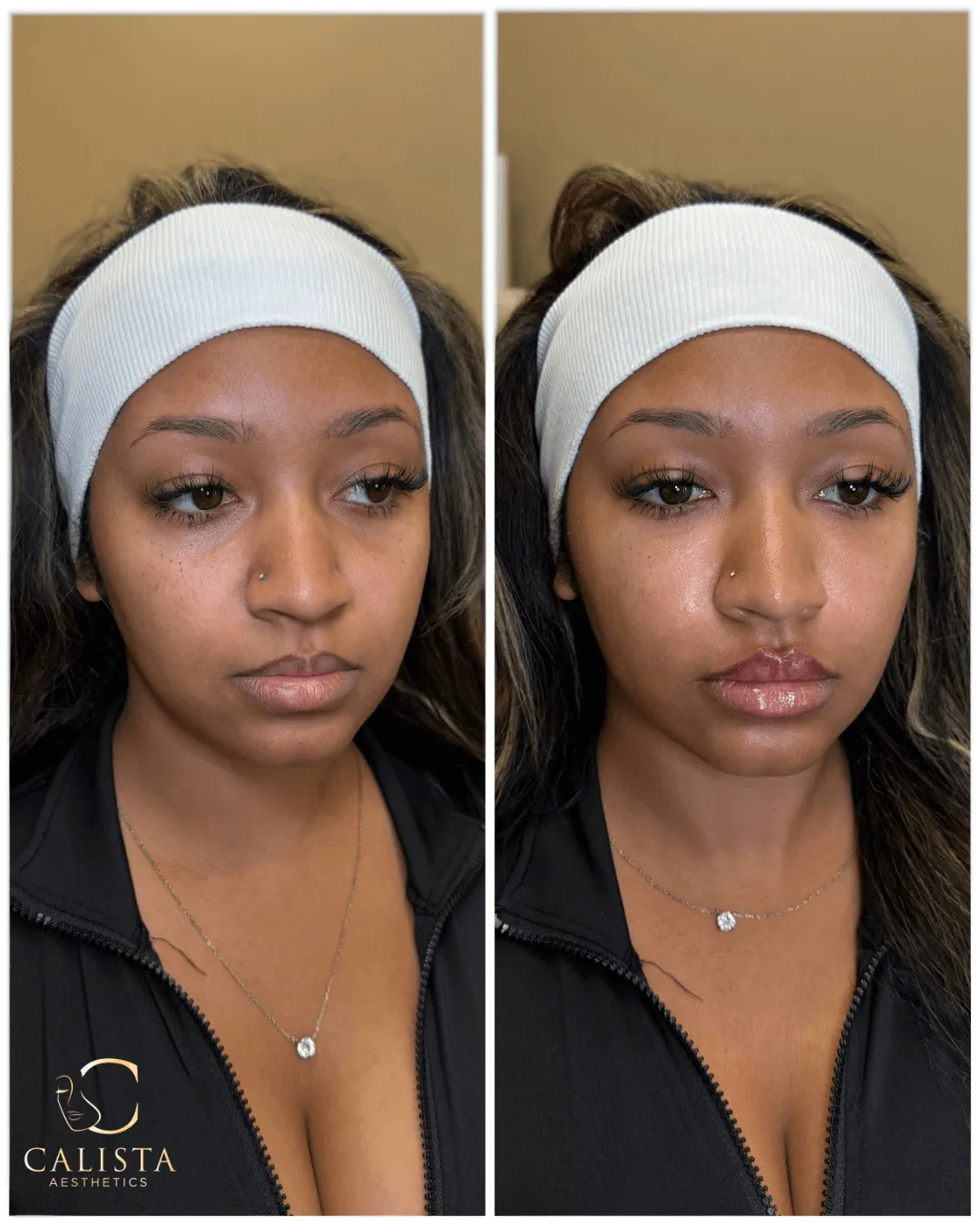 Before and after image of a woman showing lip enhancement results, with fuller, glossier lips and subtle facial rejuvenation, branded with Calista Aesthetics.