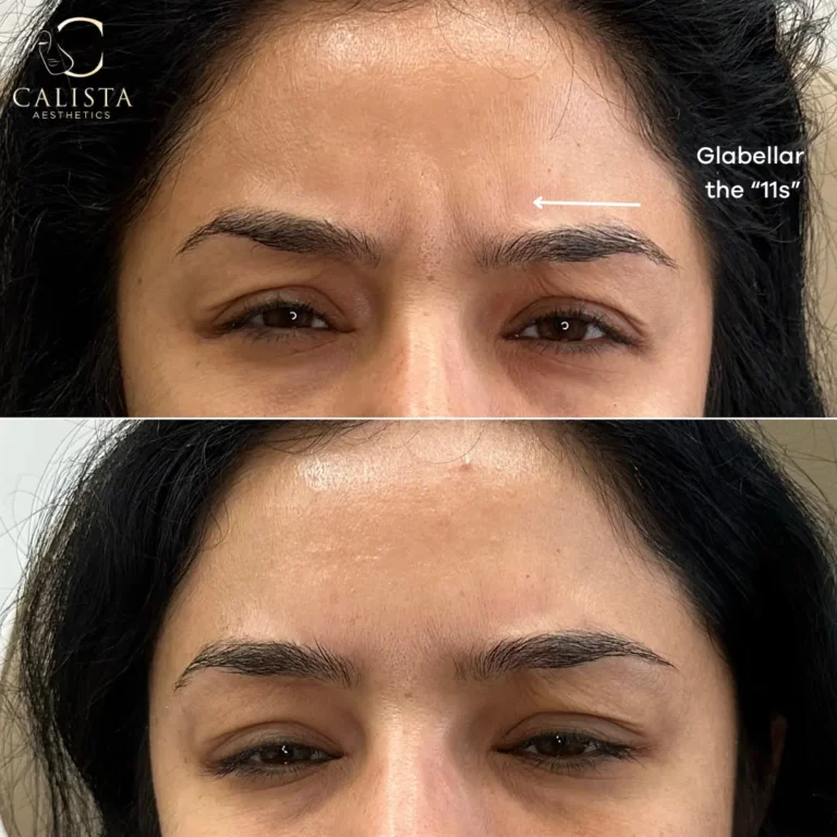 Before and after images of a woman showing the results of a treatment targeting glabellar lines, also known as the "11s," located between the eyebrows. The "before" image highlights deep frown lines in the glabellar area, while the "after" image shows a smoother forehead with significantly reduced lines.