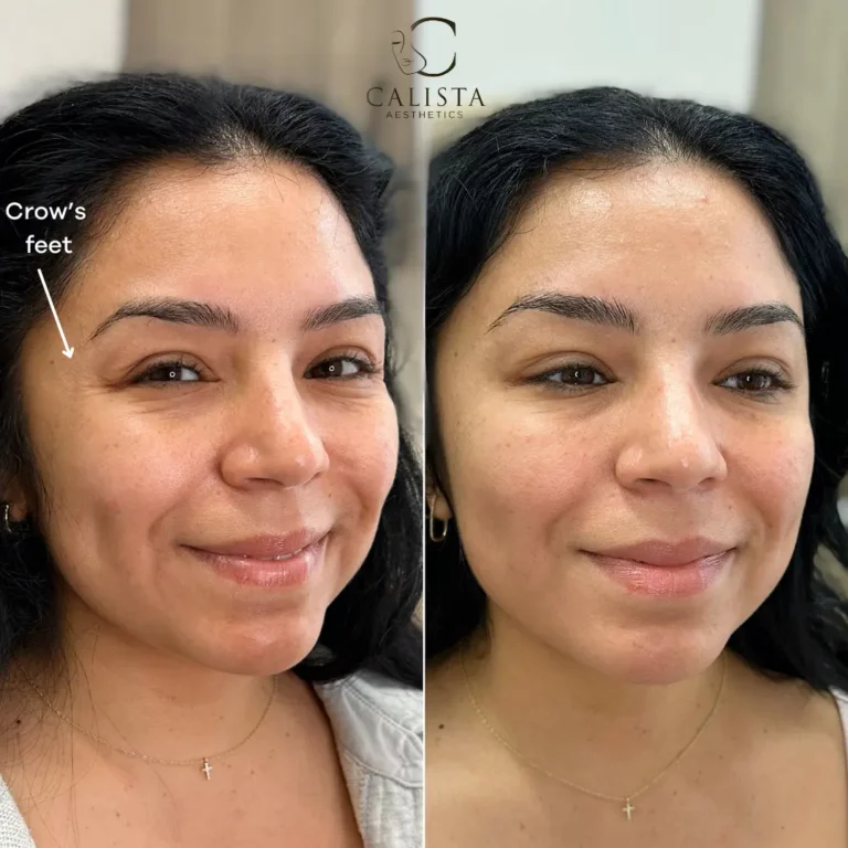 Before and after images of a woman showing the results of a treatment targeting crow's feet (fine lines around the eyes). The "before" image highlights visible crow's feet when smiling, while the "after" image reveals smoother skin around the eyes with significantly reduced lines, giving a more youthful and refreshed appearance.