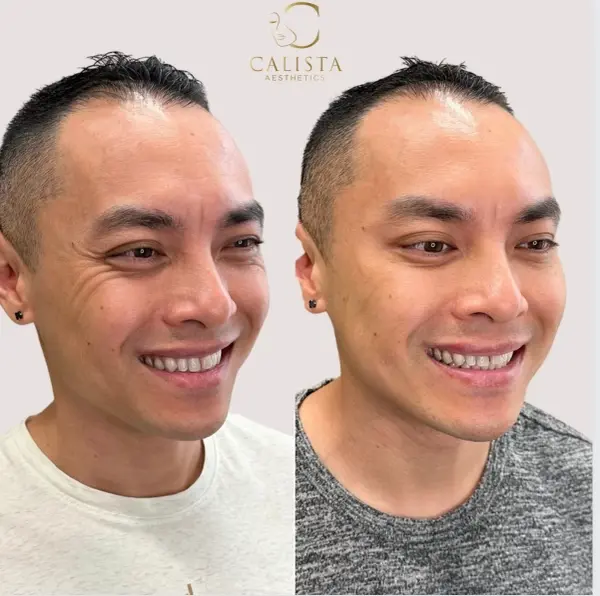 Before and after images of a man smiling, showing the results of a treatment aimed at reducing smile lines and wrinkles around the eyes. The "before" image shows prominent crow’s feet and lines when smiling, while the "after" image reveals smoother skin around the eyes with fewer visible wrinkles, maintaining a natural smile. Dysport.