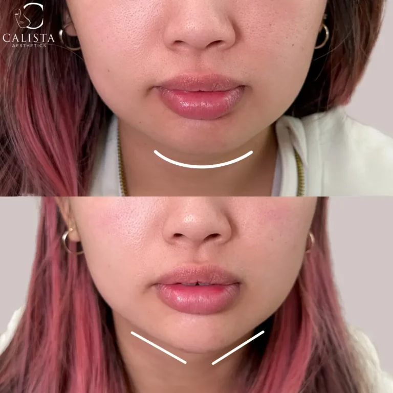 Before and after images of a woman showing the results of a chin contouring procedure. The "before" image highlights a rounded chin, while the "after" image reveals a more defined and V-shaped chin, enhancing the overall symmetry and contour of the lower face. Chin filler.