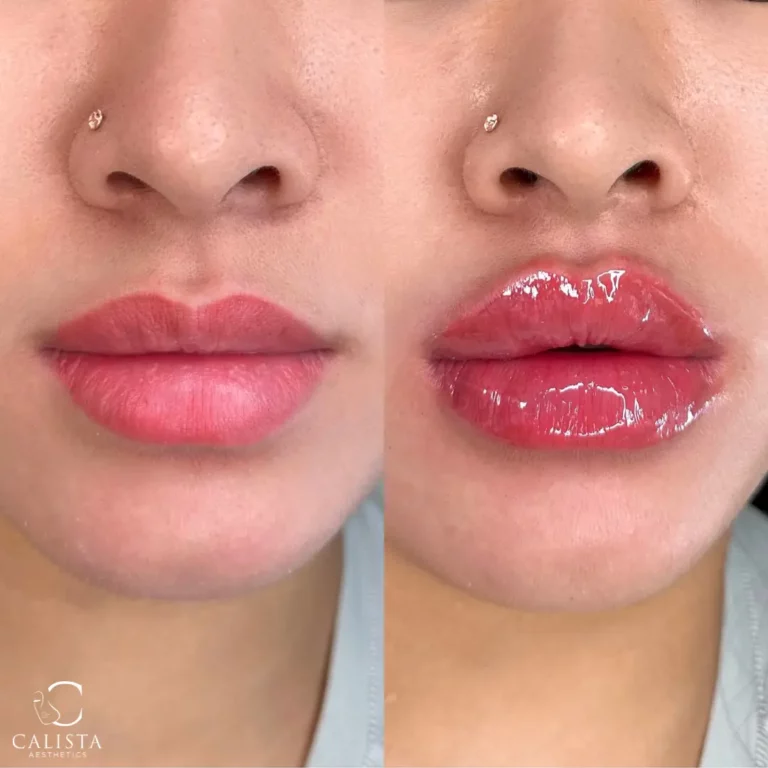 Before and after images of a woman showcasing the results of a lip filler treatment. The "before" image shows her natural lips, while the "after" image reveals significantly fuller, plumper lips with a high-gloss finish, enhancing both volume and definition.
