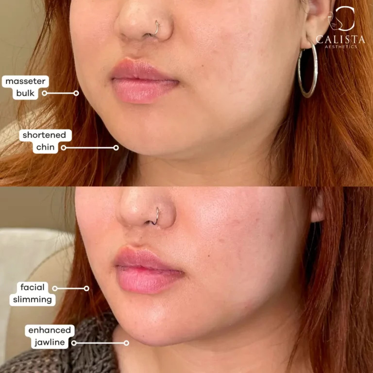 Before and after images of a woman showing the results of facial contouring treatments. The "before" image highlights masseter bulk and a shortened chin, while the "after" image shows facial slimming and an enhanced jawline, creating a more defined and balanced facial appearance. Chin filler.