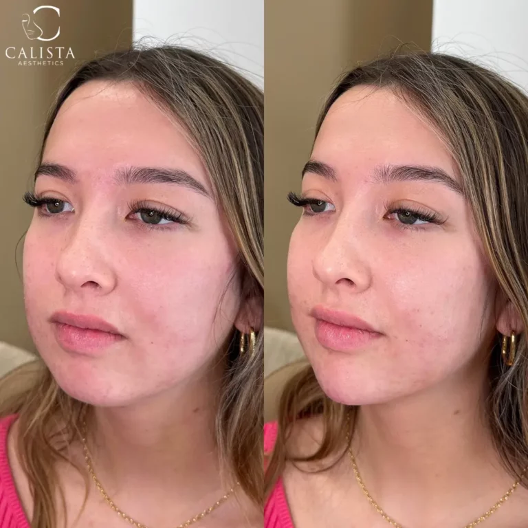 Before and after images of a woman showing the results of a facial treatment. The "before" image displays slight redness and uneven texture, while the "after" image reveals a smoother complexion with reduced redness and a more even skin tone, giving a refreshed and clear appearance. Chin filler.