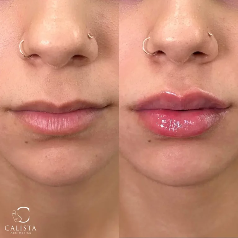 Before and after images of a woman showing the results of a lip filler procedure. The "before" image displays her natural lips, while the "after" image reveals fuller, more voluminous lips with a glossy finish, enhancing both shape and definition.