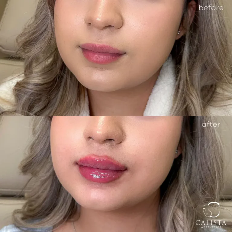 Before and after images of a woman showing the results of a lip enhancement procedure. The "before" image displays her natural lips, while the "after" image reveals fuller, more defined lips with a glossy finish, creating a plumper and more voluminous appearance. Lip filler.