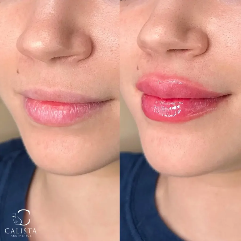Before and after images of a woman showing the results of a lip filler treatment. The "before" image displays her natural lips, while the "after" image reveals fuller and more defined lips with a glossy finish, enhancing both volume and shape.