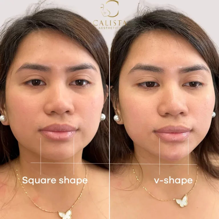Before and after images of a woman showing the results of a facial contouring treatment. The "before" image highlights a square-shaped jawline, while the "after" image shows a more refined and slender V-shaped jawline, emphasizing a smoother and more contoured lower face. Chin filler.
