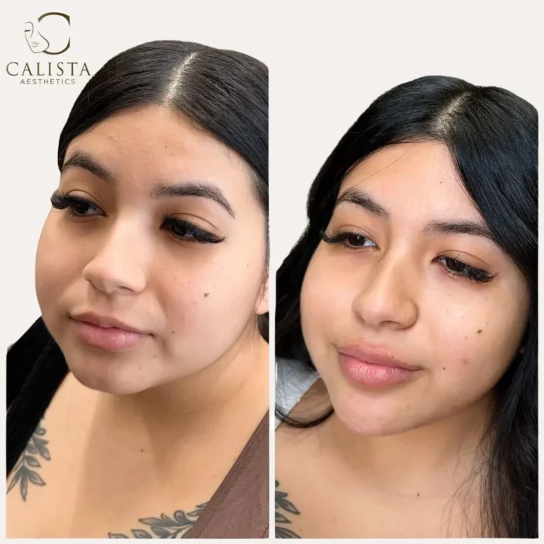 Before and after images of a woman showing the results of facial slimming treatments. The "before" image displays a fuller facial appearance, while the "after" image reveals a more contoured and refined face, highlighting a slimmer and more defined jawline and cheeks.