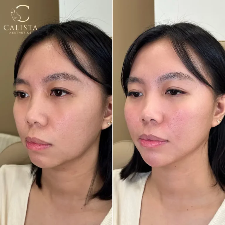 Before and after images of a woman showing the results of a facial treatment. The "before" image displays natural skin texture, while the "after" image reveals a more refined and smoother complexion, with subtle improvements in skin tone and texture, giving a fresher and more radiant appearance. Cheek filler, smile lines, jawline slimming, chin filler, chin shadow.
