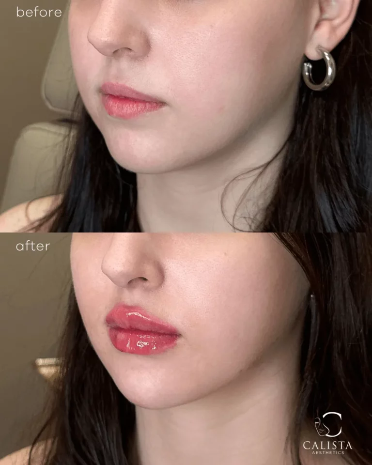 Before and after image of a woman’s lips showing increased volume, definition, and shine after lip filler enhancement at Calista Aesthetics.