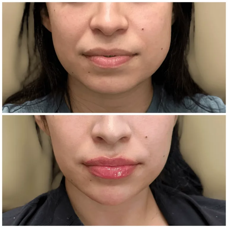Top and bottom comparison of a woman’s lower face, illustrating lip filler augmentation—top photo shows natural thin lips, bottom photo reveals fuller glossy lips after cosmetic treatment